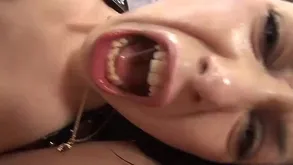 advanced anal prolapse